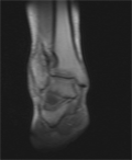 Osteochondroma near ankle