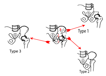 Types of pelvic resections
