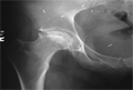 X ray showing avascular necrosis of the hip