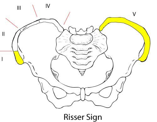 Risser's sign measures age from development of the growth plate of the Iliac apophysis