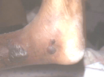 Fracture blisters from an unreduced ankle fracture