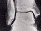 X ray showing a non displaced talus within ankle mortice