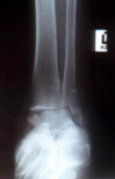 Weber B ankle fracture
