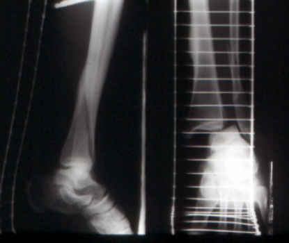 Weber C fracture of the ankle