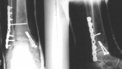 ORIF of a Weber C fracture using lateral plate and syndesmosis screw