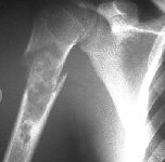 Fracture through a simple bone cyst