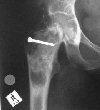 Intraosseous ganglion treated with bone graft