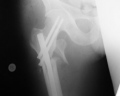 Fracture on the right fixed with a cephallomedullary pin