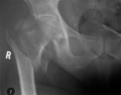 Extracasular fracture of the proximal femur