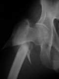 Unstable extracapsular proximal femoral fracture
