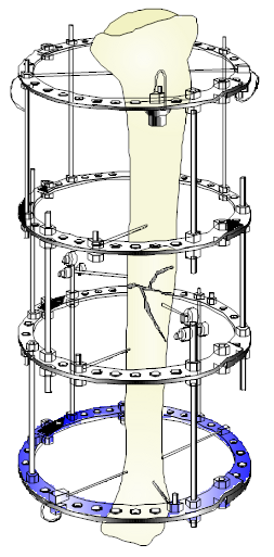 Fractura tibial fijada con un marco de Ilizarov