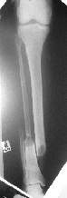 Xray of tibia fracture