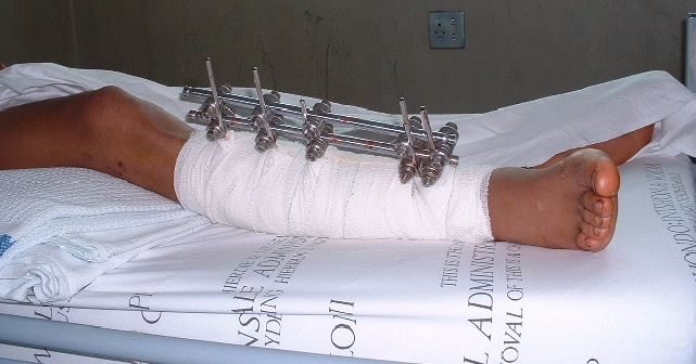 Closed Fracture Arm