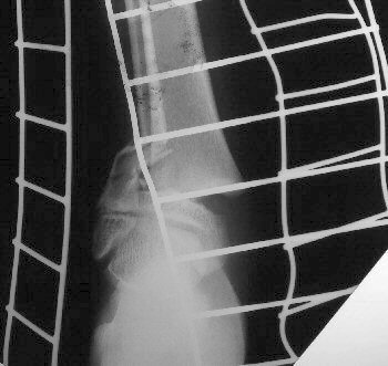 Initial X Ray of a Salter Harris II growth plate injury of the distal tibia