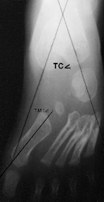 X ray of Skewfoot