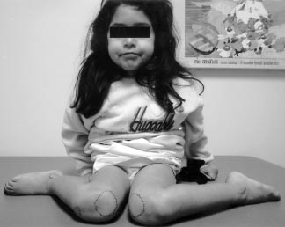 Child sitting in the W position - a sign of excessive femoral anteversion