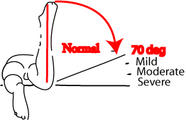 Drawing showing hos anteversion causes increased hip internal rotation