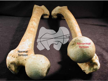 Anteversion of the proximal femur