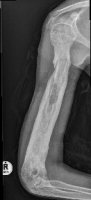 Lateral view of humerus with chronic osteomyelitis and sequestrum
