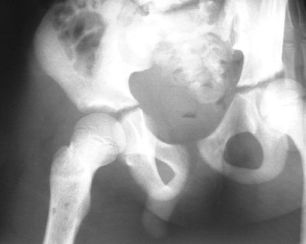 Widening of joint space and drill holes in the 
			  metaphysis denote acute osteomyelitis. Pus has also entered the hip causing an acute arthritis