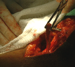 Ligament repair posterior dislocation of knee