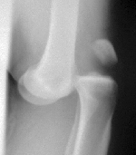Anterior knee dislocation