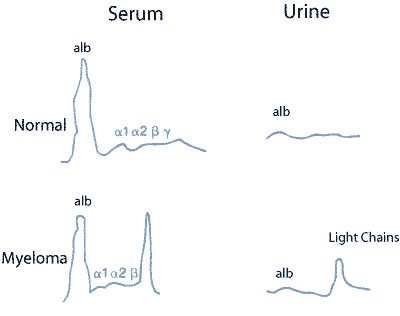 Electrophoresis patterns in plasma and urine, both normal and in Myeloma