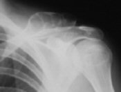 Aneurysmal Bone Cyst of the clavicle