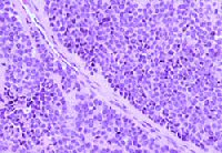 Ewings - small cell tumor