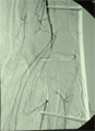Arteriogram after a knee dislocation