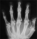 Xray: Hyperparathyroidism of hands