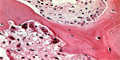 Histology of hyperparathyroidism in bone