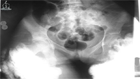 X ray of tumoral calcinosis