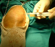 Aspiration of knee for suspected septic arthritis