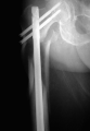 Cephallomedullary pin for proximal femur fracture