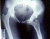 X ray of anterior hip dislocation