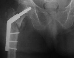 Same fracture treated with a sliding screw and plate