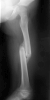 United femur shaft fracture in a child showing bone overlap