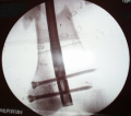 Retrograde IM femoral intramedullary pin inserted through the knee