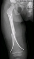 Femur fracture treated by TENS nails