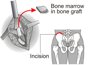 Harvesting bone from the posterior pelvis for grafting
