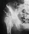 Girdlestone excision arthroplasty of the hip