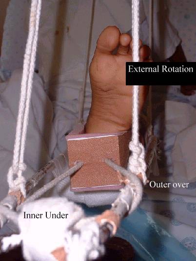 Rigging a Thomas splint - Inner under outer over method