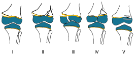 Illustration of the Salter Harris classification of growth plate injuries