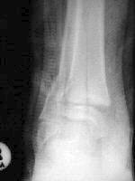 Salter Harris II fracture of the distal tibia