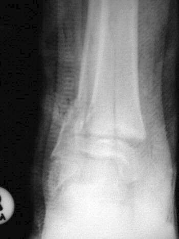 X Ray showing unsatisfactory closed reduction - due to periosteum in the fracture line through the growth plate