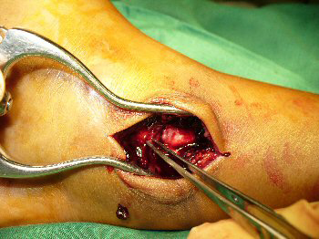 Operative photograph: Removing the periosteum from within the growth plate fracture line 