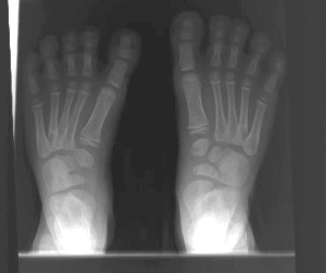 X ray image of a child's foot