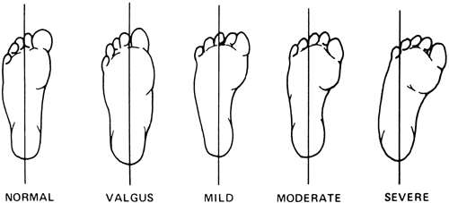 Internal Rotation deformities of the lower limb