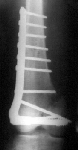 Intracondylar fracture fixed with sliding screw and plate